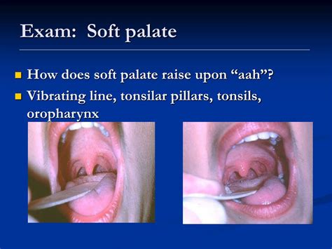 how to test rise of soft palate|examination of palatal function.